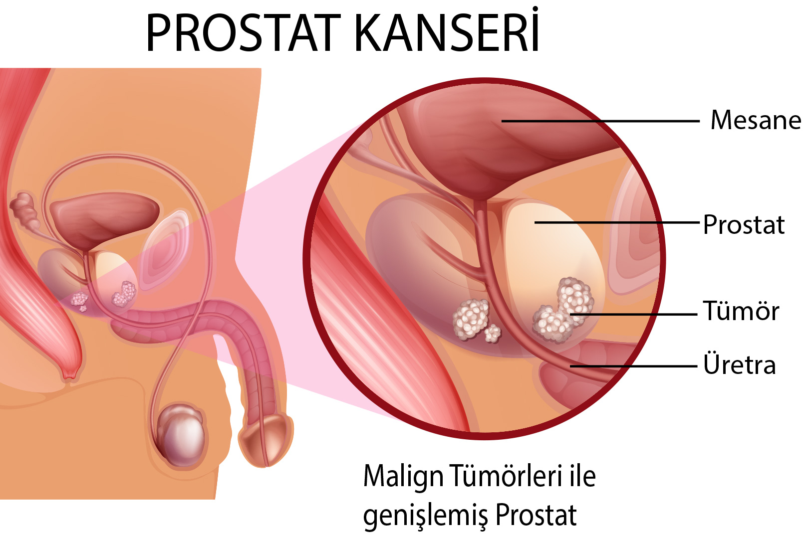 Uzm Dr Yaman Sa Lam Hastal Klar Prostat Kanseri Genetik Testler